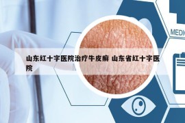 山東紅十字醫(yī)院治療牛皮癬 山東省紅十字醫(yī)院
