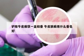 鏟除牛皮癬獲一盒蚊香 牛皮膚癬用什么香皂好