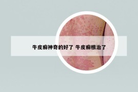 牛皮癬神奇的好了 牛皮癬根治了