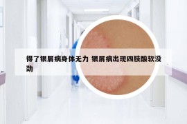 得了銀屑病身體無力 銀屑病出現(xiàn)四肢酸軟沒勁