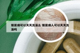 銀屑病可以天天洗澡么 銀屑病人可以天天洗澡嗎
