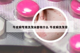 牛皮癬專用洗發(fā)水都有什么 牛皮癬洗發(fā)膏