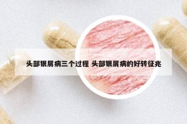 頭部銀屑病三個(gè)過程 頭部銀屑病的好轉(zhuǎn)征兆
