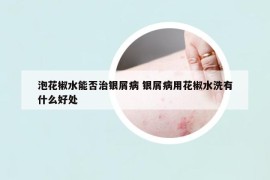 泡花椒水能否治銀屑病 銀屑病用花椒水洗有什么好處
