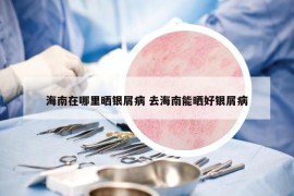 海南在哪里曬銀屑病 去海南能曬好銀屑病