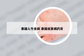 泰國人牛皮癬 泰國皮膚病藥膏