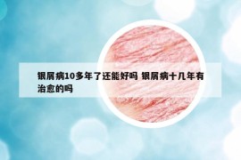 銀屑病10多年了還能好嗎 銀屑病十幾年有治愈的嗎