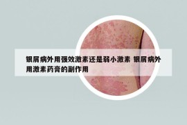 銀屑病外用強(qiáng)效激素還是弱小激素 銀屑病外用激素藥膏的副作用