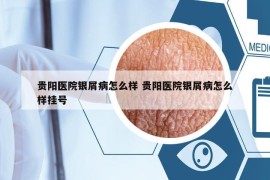 貴陽(yáng)醫(yī)院銀屑病怎么樣 貴陽(yáng)醫(yī)院銀屑病怎么樣掛號(hào)
