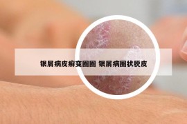 銀屑病皮癬變?nèi)θ?銀屑病圈狀脫皮