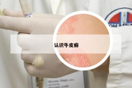 認(rèn)識(shí)牛皮癬