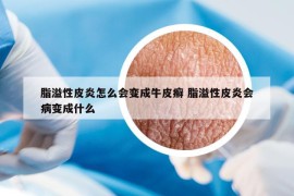 脂溢性皮炎怎么會變成牛皮癬 脂溢性皮炎會病變成什么