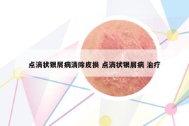點(diǎn)滴狀銀屑病清除皮損 點(diǎn)滴狀銀屑病 治療