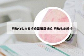 后腦勺頭皮長痘痘是銀屑病嗎 后腦頭皮起痘