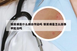 銀屑病是什么病會(huì)傳染嗎 銀屑病是怎么回事啊能治嗎