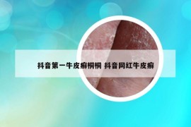 抖音第一牛皮癬桐桐 抖音網(wǎng)紅牛皮癬