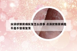 水滴狀銀屑病反復怎么回事 點滴狀銀屑病是不是不容易復發(fā)