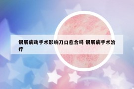 銀屑病動(dòng)手術(shù)影響刀口愈合嗎 銀屑病手術(shù)治療