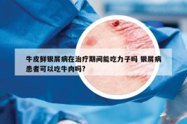 牛皮鮮銀屑病在治療期間能吃力子嗎 銀屑病患者可以吃牛肉嗎?