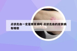 點(diǎn)狀出血一定是銀屑病嗎 點(diǎn)狀出血的皮膚病有哪些