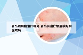 青島銀屑病治療曝光 青島有治療銀屑病好的醫(yī)院嗎