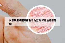 長春銀屑病醫(yī)院排名華山咨詢 長春治療銀屑病
