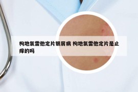 枸地氯雷他定片銀屑病 枸地氯雷他定片是止癢的嗎