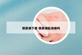 銀屑病下雨 銀屑病能淋雨嗎