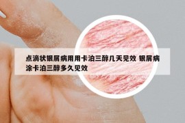 點(diǎn)滴狀銀屑病用用卡泊三醇幾天見(jiàn)效 銀屑病涂卡泊三醇多久見(jiàn)效