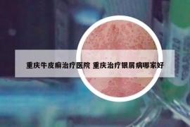 重慶牛皮癬治療醫(yī)院 重慶治療銀屑病哪家好