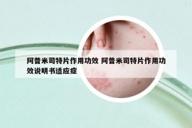 阿普米司特片作用功效 阿普米司特片作用功效說明書適應(yīng)癥