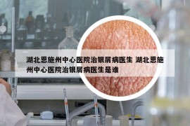 湖北恩施州中心醫(yī)院治銀屑病醫(yī)生 湖北恩施州中心醫(yī)院治銀屑病醫(yī)生是誰