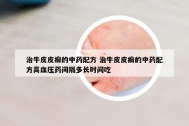 治牛皮皮癬的中藥配方 治牛皮皮癬的中藥配方高血壓藥間隔多長(zhǎng)時(shí)間吃