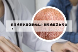 銀屑病起到耳朵里怎么辦 銀屑病耳朵有發(fā)炎了