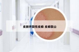 皮膚開裂性皮癬 皮癬裂口
