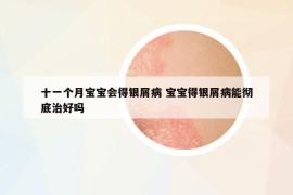 十一個月寶寶會得銀屑病 寶寶得銀屑病能徹底治好嗎