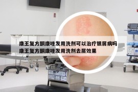 康王復(fù)方酮康唑發(fā)用洗劑可以治療銀屑病嗎 康王復(fù)方酮康唑發(fā)用洗劑去屑效果