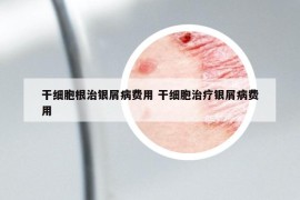 干細胞根治銀屑病費用 干細胞治療銀屑病費用
