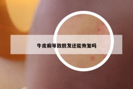 牛皮癬導(dǎo)致脫發(fā)還能恢復(fù)嗎