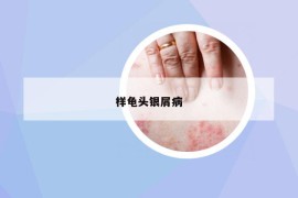 樣龜頭銀屑病