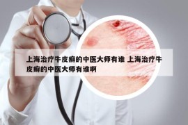 上海治療牛皮癬的中醫(yī)大師有誰(shuí) 上海治療牛皮癬的中醫(yī)大師有誰(shuí)啊