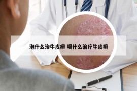 泡什么治牛皮癬 喝什么治療牛皮癬