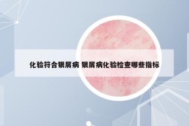 化驗符合銀屑病 銀屑病化驗檢查哪些指標