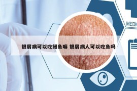銀屑病可以吃鰻魚嘛 銀屑病人可以吃魚嗎