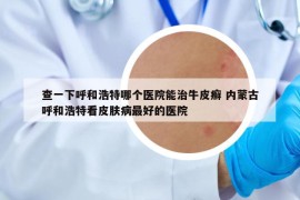 查一下呼和浩特哪個(gè)醫(yī)院能治牛皮癬 內(nèi)蒙古呼和浩特看皮膚病最好的醫(yī)院