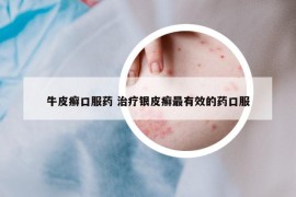牛皮癬口服藥 治療銀皮癬最有效的藥口服