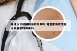 電池水淡硫酸能治銀屑病嗎 電池水淡硫酸能治銀屑病嗎有毒嗎