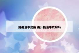鮮姜治牛皮癬 姜汁能治牛皮癬嗎