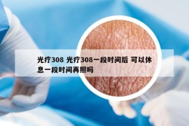 光療308 光療308一段時間后 可以休息一段時間再照嗎