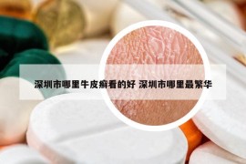深圳市哪里牛皮癬看的好 深圳市哪里最繁華